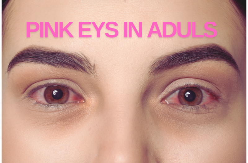 Pink Eye In Adults Causes Symptoms Treatment And Home Remedies Proliferx 